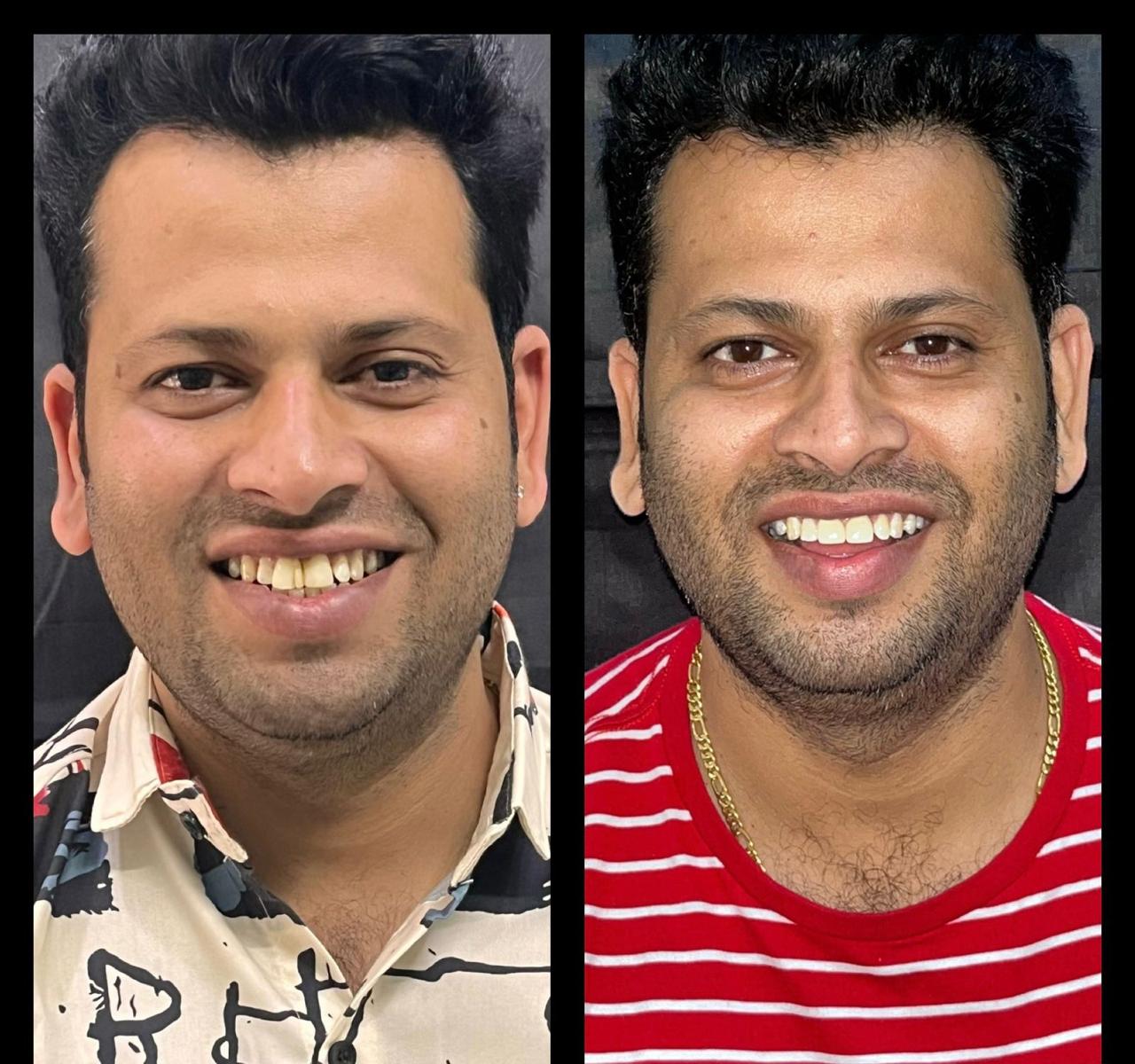 Smile Makeover