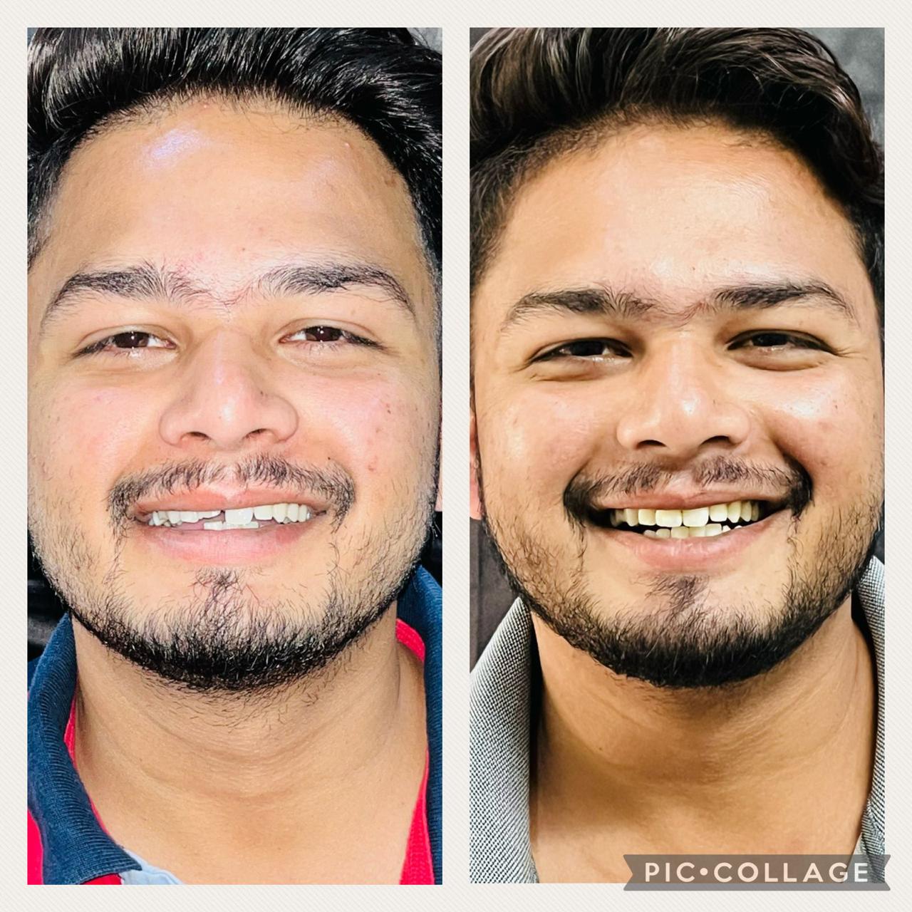 Smile Correction