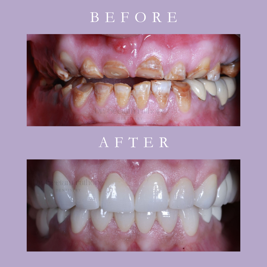 Full Mouth Veneers