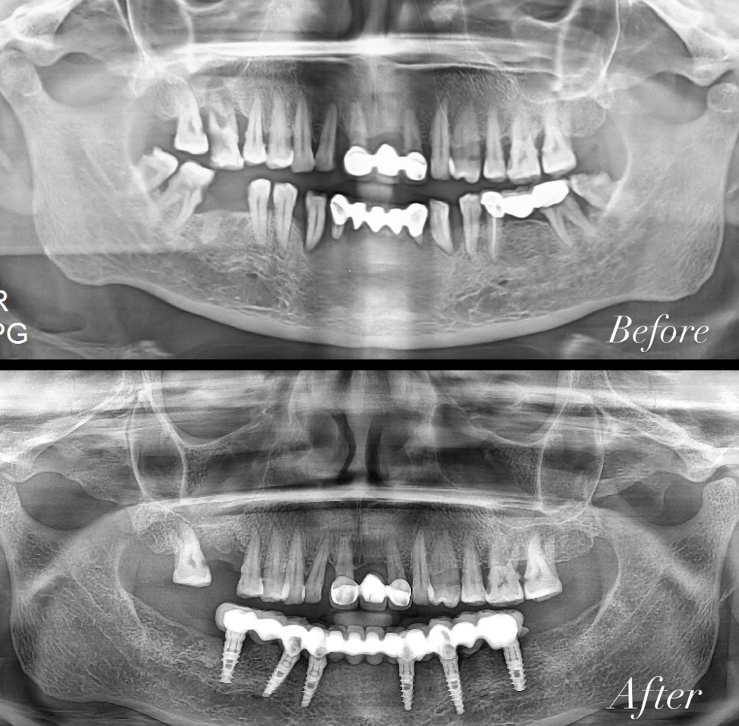 Full Arch Implants