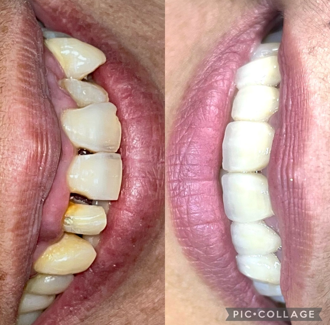 Smile Restoration