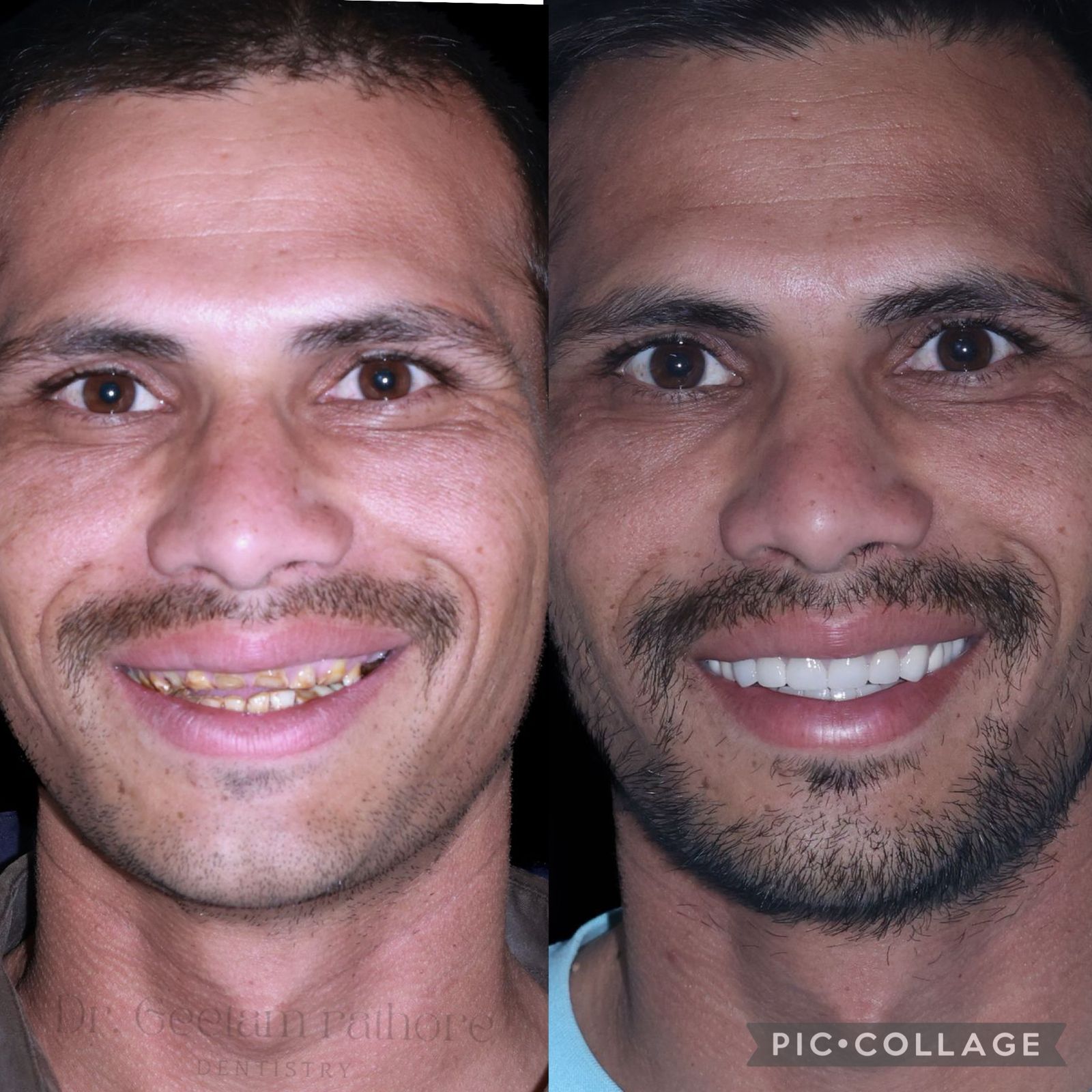 Smile Makeover