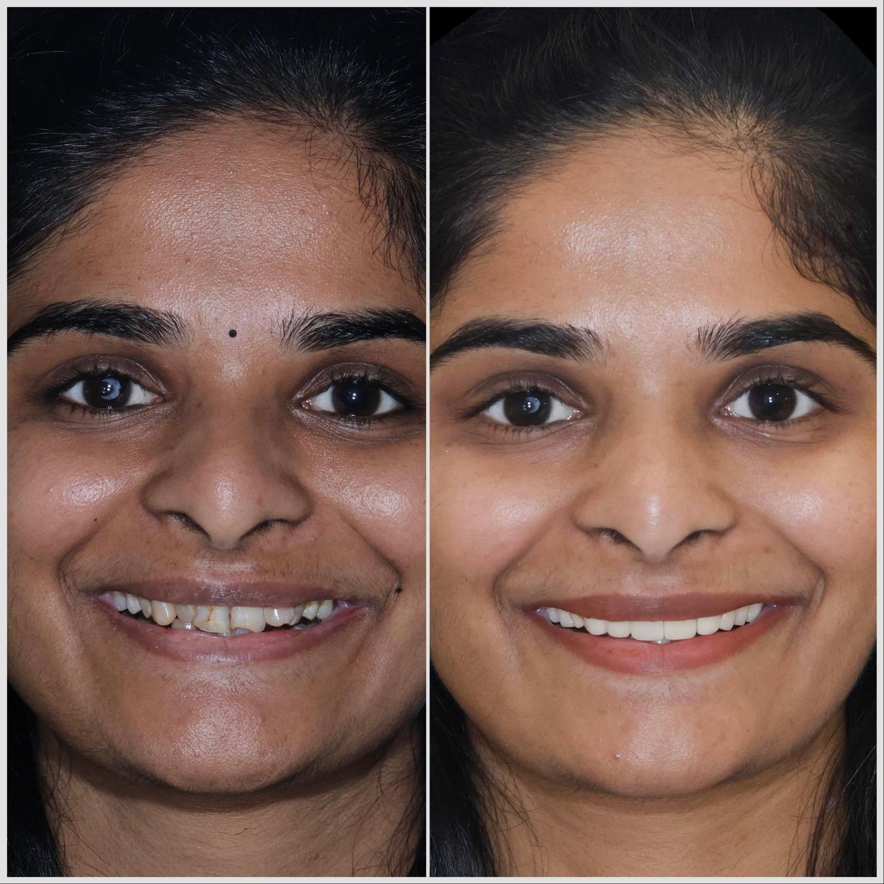 Smile Transformation