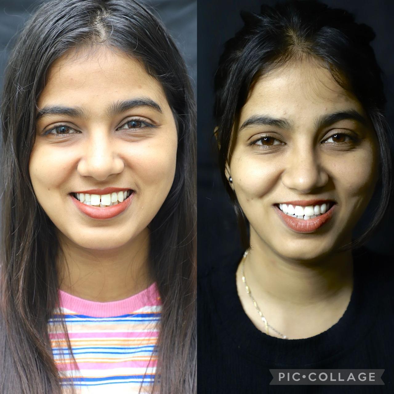 Porcelain Veneers