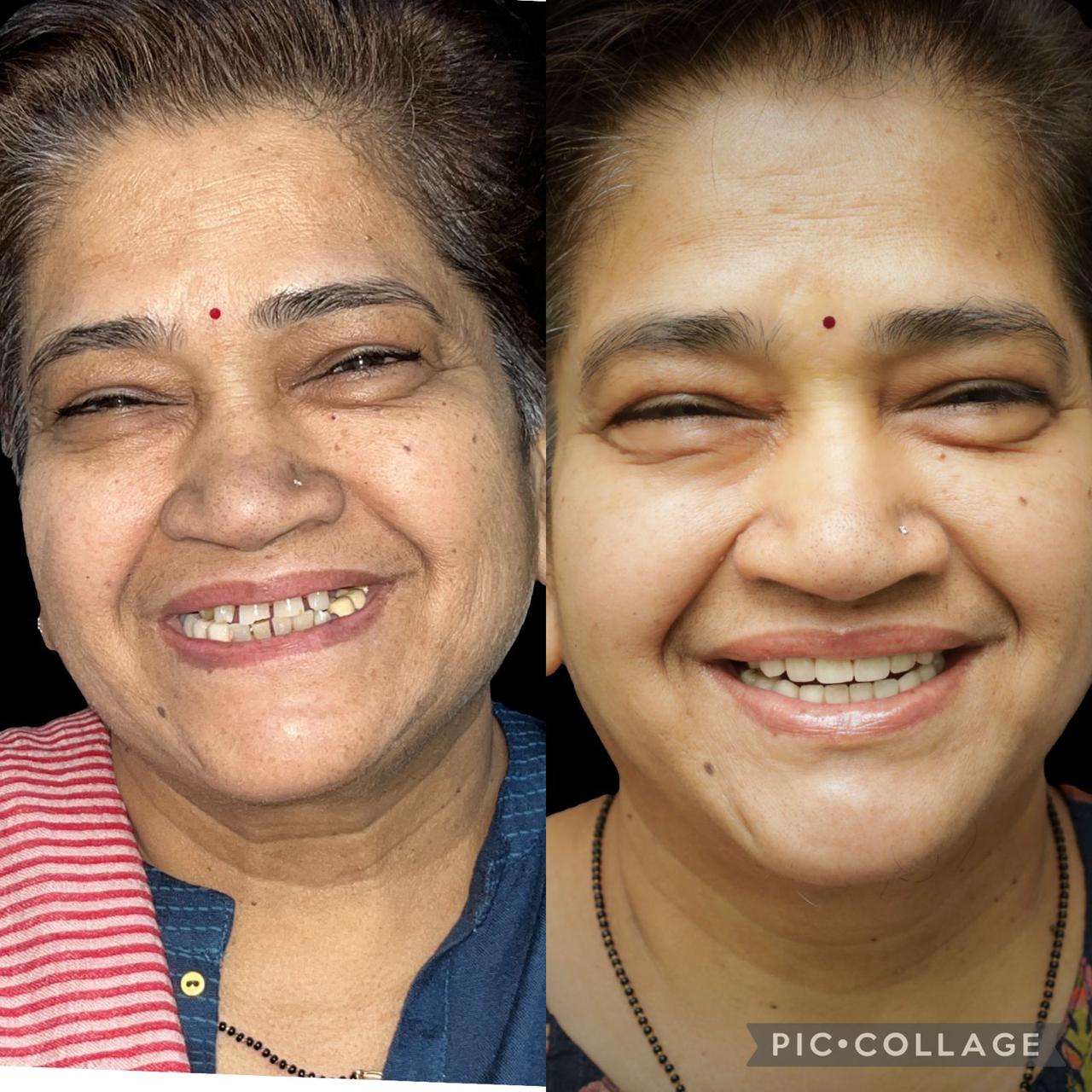 Full Rehabilitation