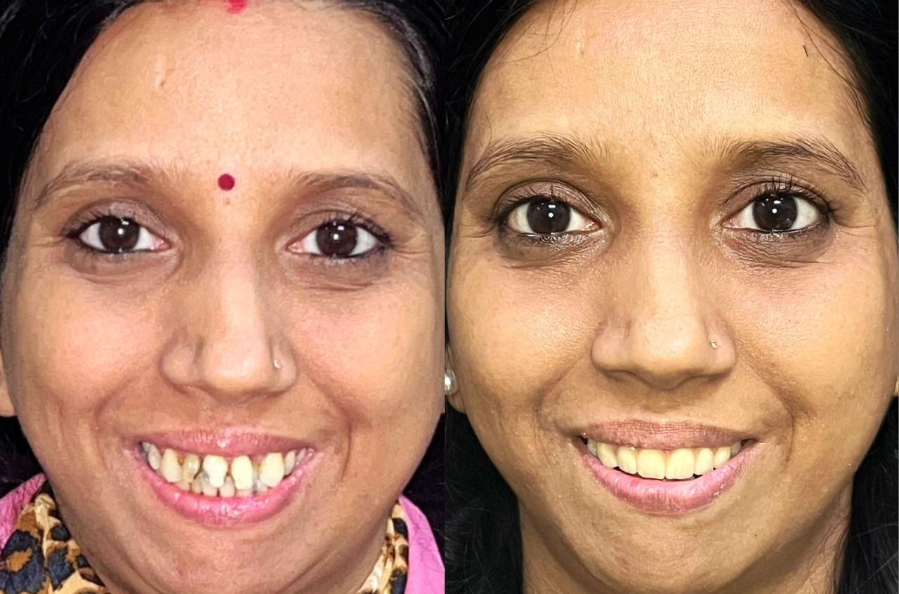 Cosmetic Veneers