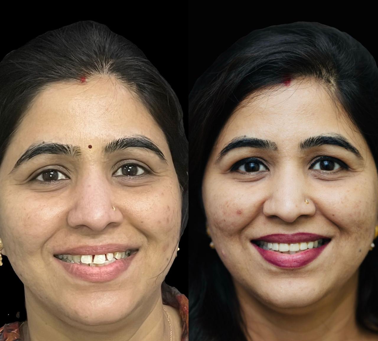 Smile Makeover
