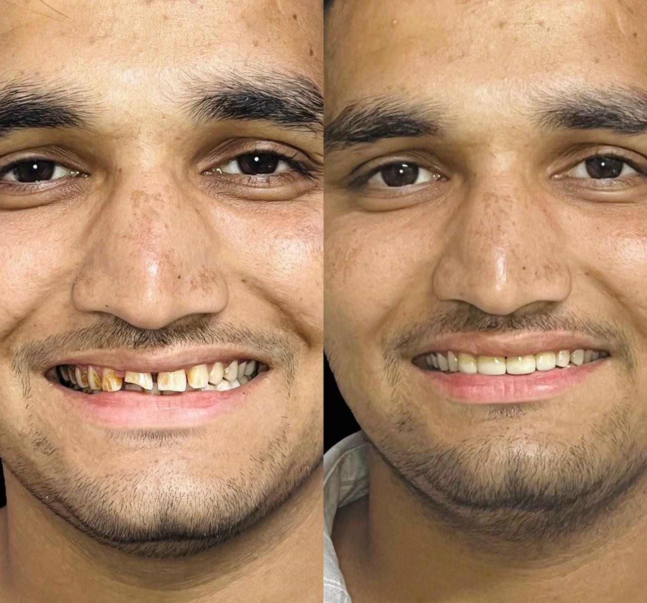 Crowns & Veneers