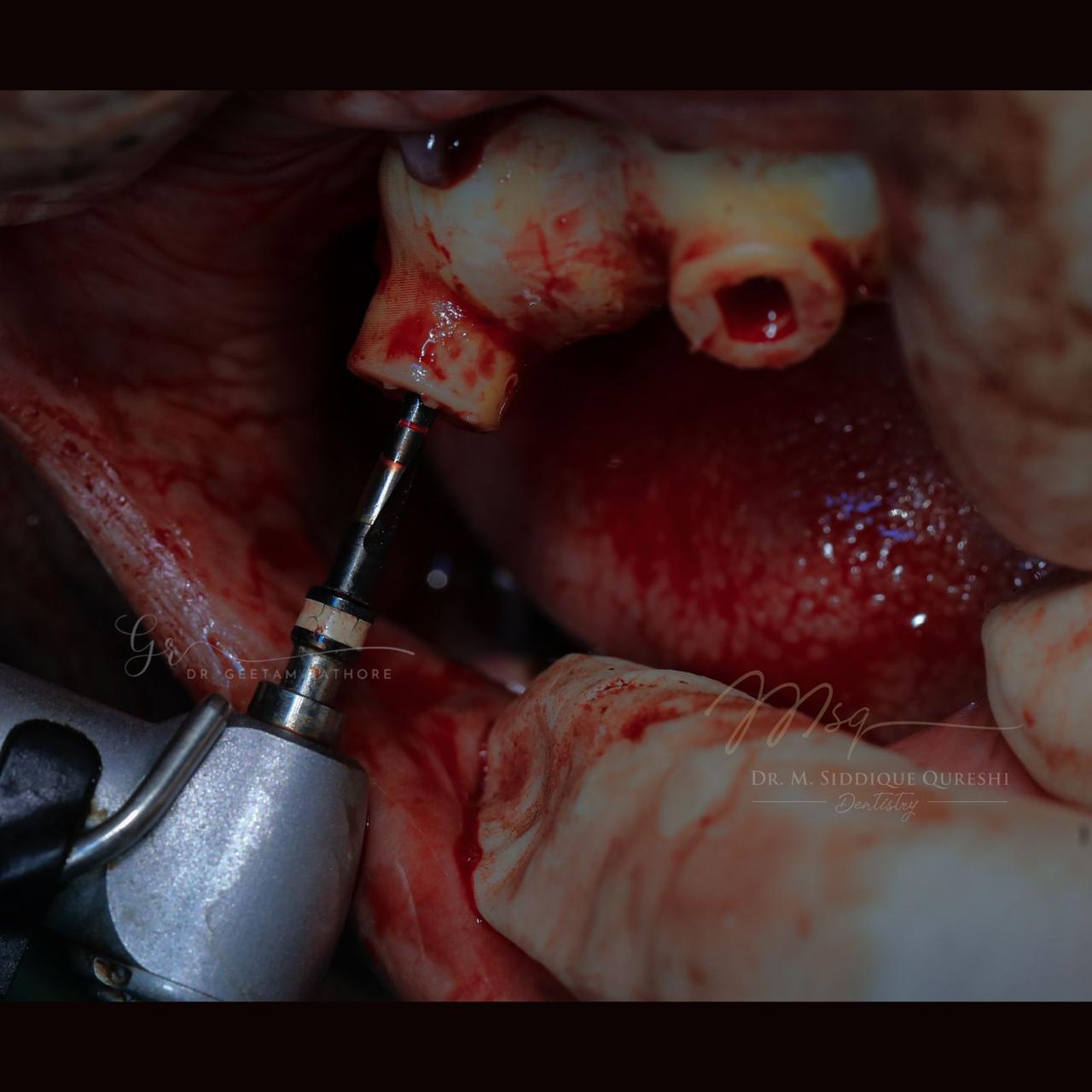 Implant Placement