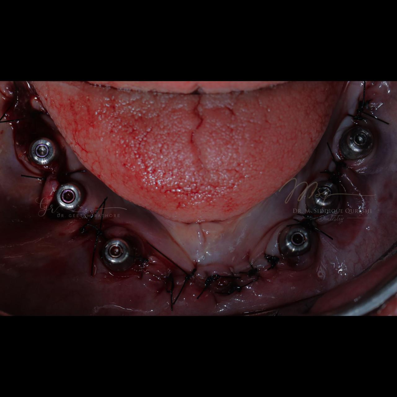 Lower Arch Surgery
