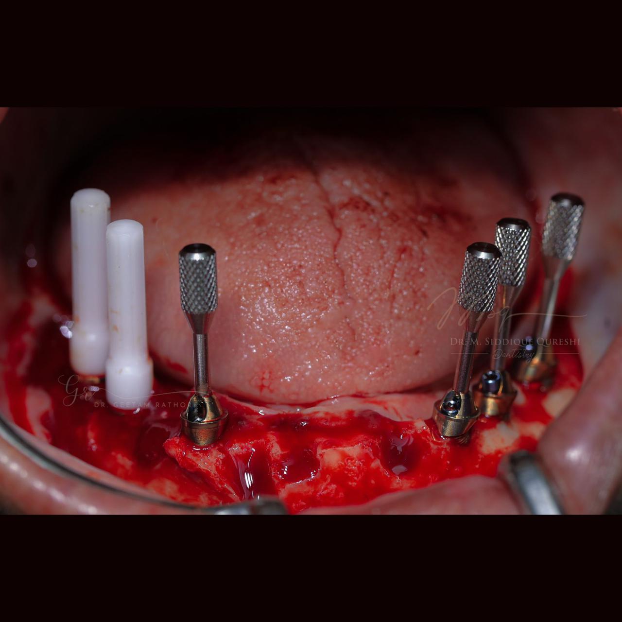 Implant Abutments