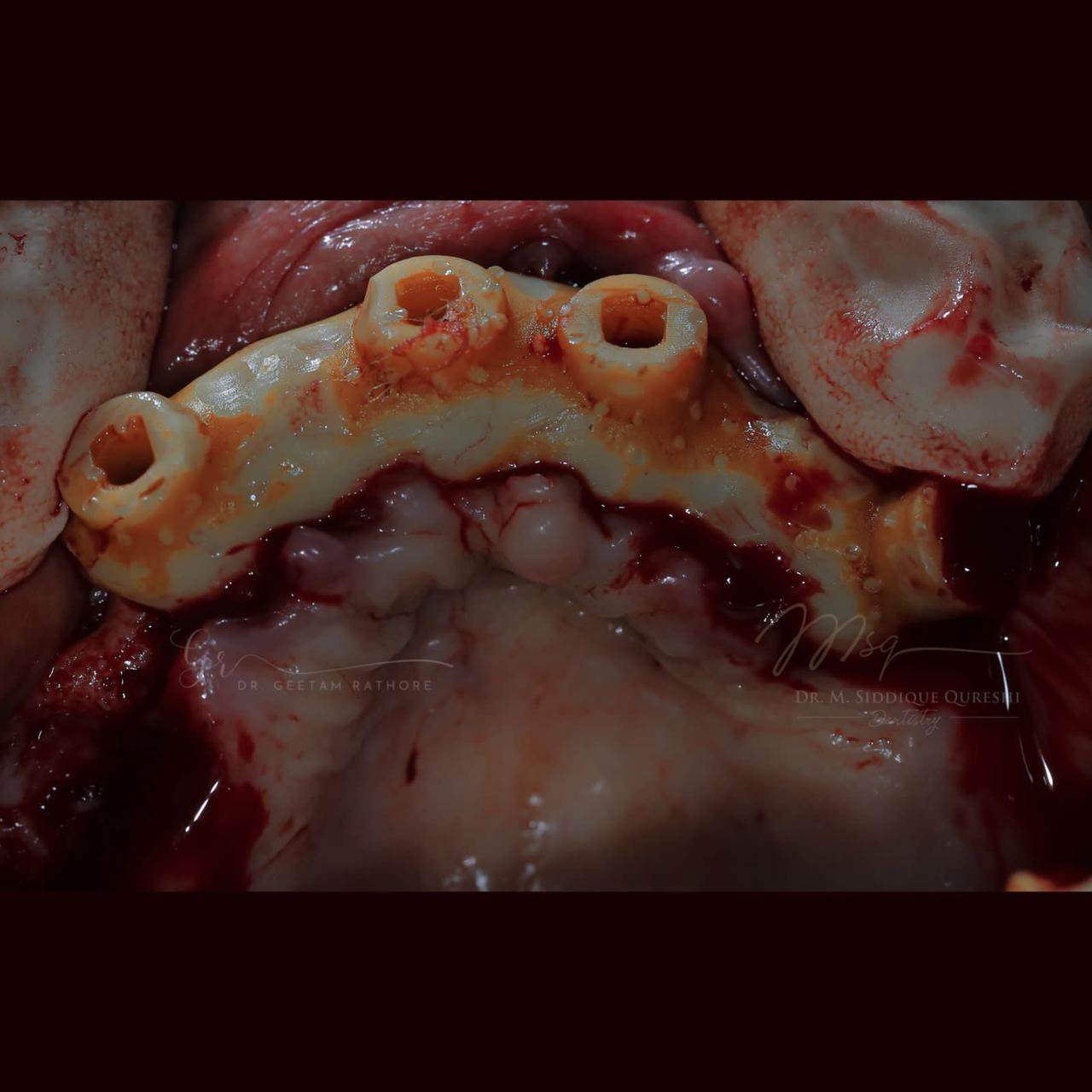 Bone Grafting