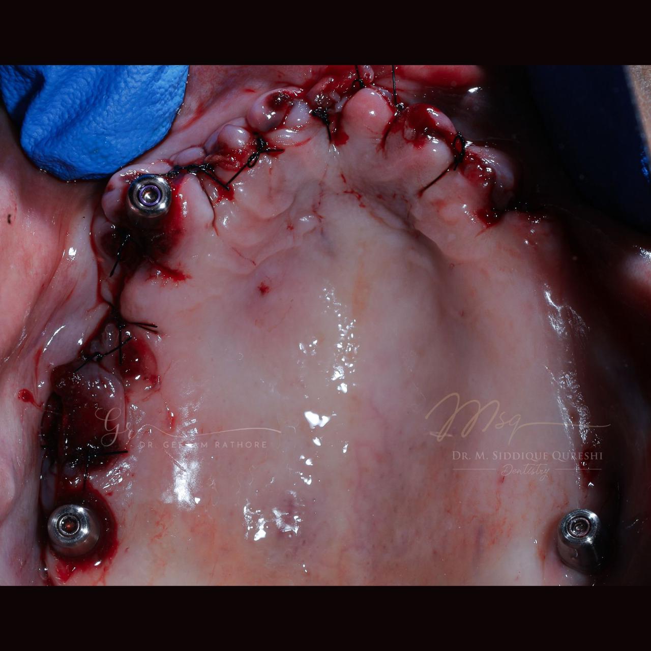 Healed Implants